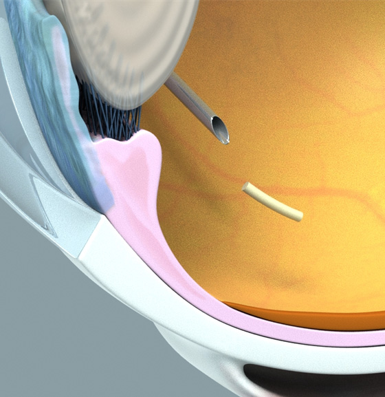 Intracameral injection of OTX-TKI implant (image)